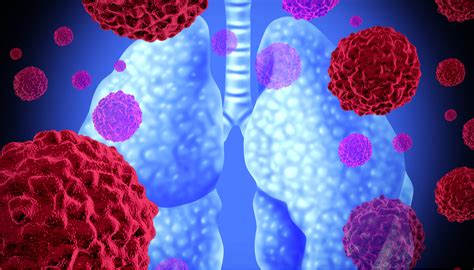 SCLC Vs NSCLC: What's The Difference? | Faculty of Medicine