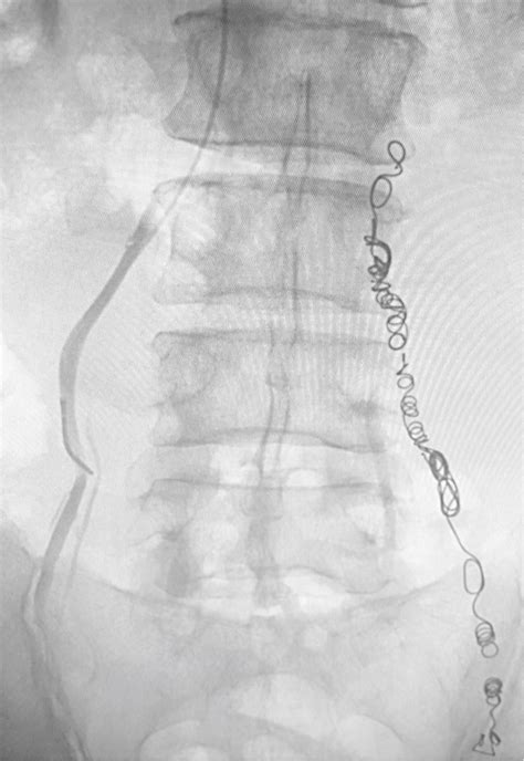 Varicocele Embolization • MTVIR