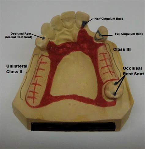 Stu-DENT Diaries: Removable Partial Denture Design