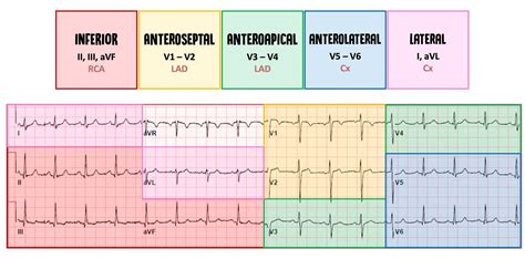 STEMI & NSTEMI: A Nurse's Comprehensive Guide | Health And Willness