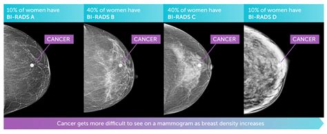 What Does Breast Cancer Look Like On Mammogram Images / Breast Density ...