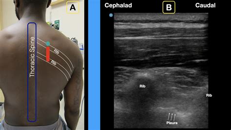 How to Perform an Erector Spinae Plane Block - Page 3 of 4 - ACEP Now ...