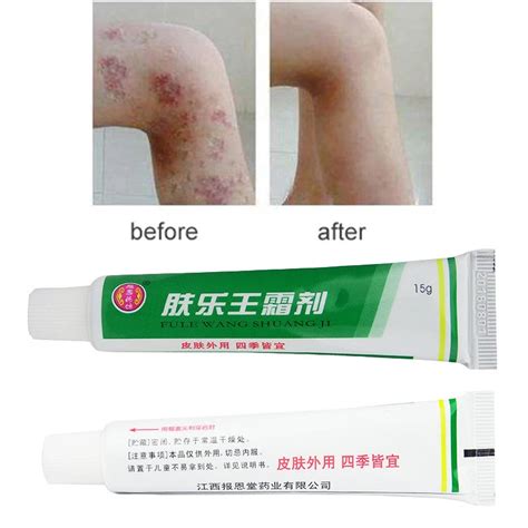 1PC Skin Psoriasis Cream Dermatitis Eczematoid Eczema Ointment ...