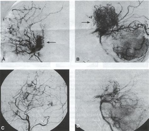 Surgical Management of Moyamoya Disease