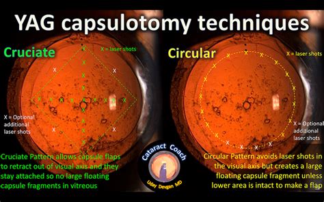 YAG Laser Capsulotomy Techniques – Cataract Coach