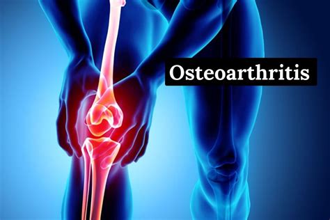 Osteoarthritis: Symptoms, Treatments, and Causes - Go Lifestyle Wiki