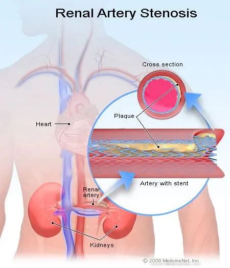 Renal Artery Stenosis Symptoms, Treatment & Tests