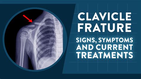 Clavicle fracture: Signs, symptoms and current treatments | Dr Geier