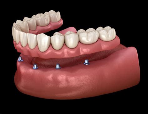 Can I Replace All My Teeth? Yes! A Dentist Explains Two Different Options