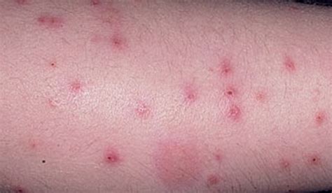 Flea Bites on Humans: Symptoms, Treatment, Pictures - YouMeMindBody