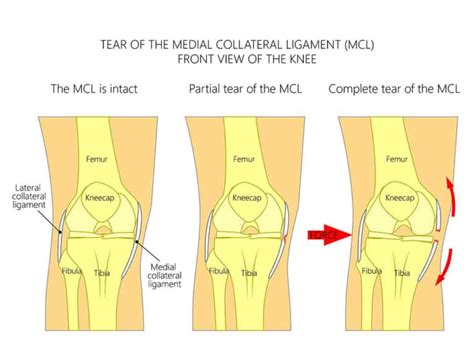 MCL Sprain Recovery Time - Injury Health Blog