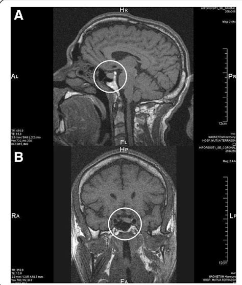 Pituitary Gland Mri Sagittal