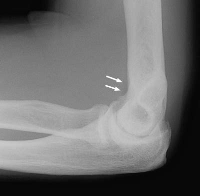 Elbow X Ray Fracture