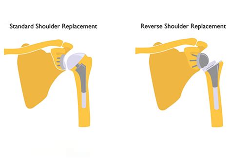 Your Guide To Reverse Shoulder Replacement And Recovery, 52% OFF