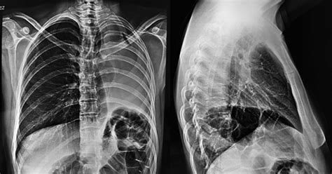 PA and lateral chest X-ray showing loss of volume of the left hemitorax ...