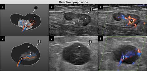 Groin Lymph Nodes Ultrasound