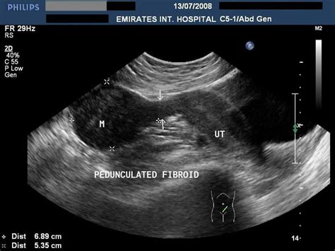 What Does Cervical Cancer Look Like On An Ultrasound - What Does