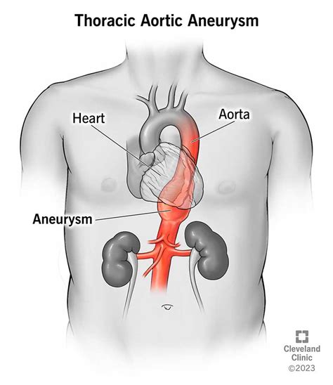 Thoracic Aortic Aneurysm Repair