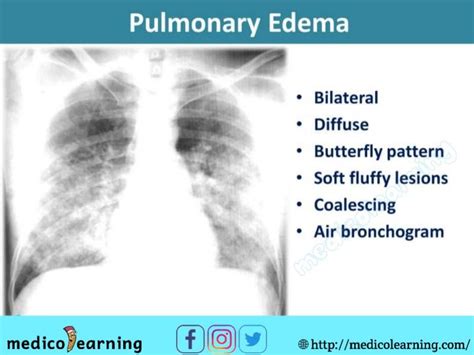 Pulmonary Edema X Ray Butterfly Pattern