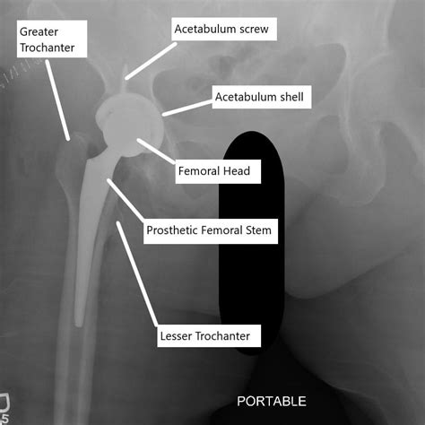 Collection 99+ Images What Does An X Ray Of The Hip Show Superb