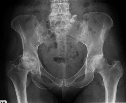 Osteoarthritis Hip X Ray Findings