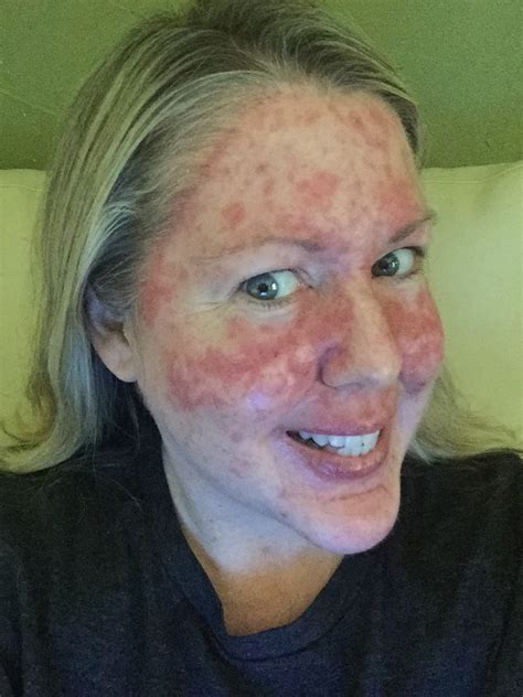 Chemo Rash On Face