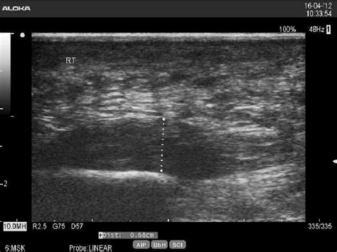 Plantar Fasciitis Ultrasound-Guided Injection Procedures ...