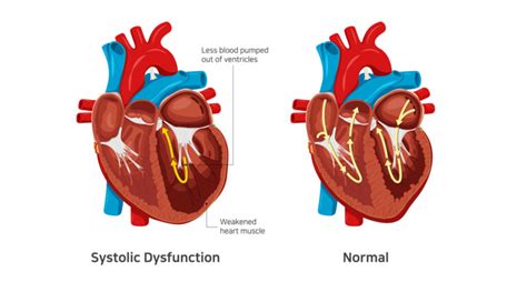 What ar Systolic Heart Failure Symptoms and Treatment | Dr. Raghu