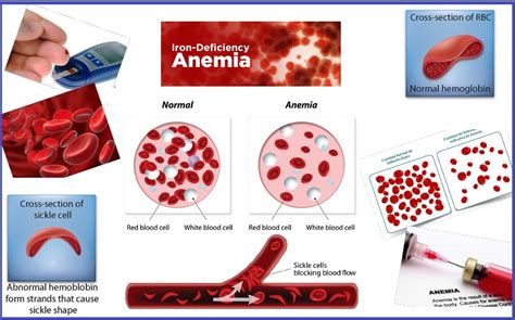 Treatment for Anemia | Homeopathic Medicine for Anemia Treatment