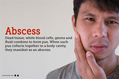 Abscess: Symptoms, Causes, Treatment, Cost, and Side Effects