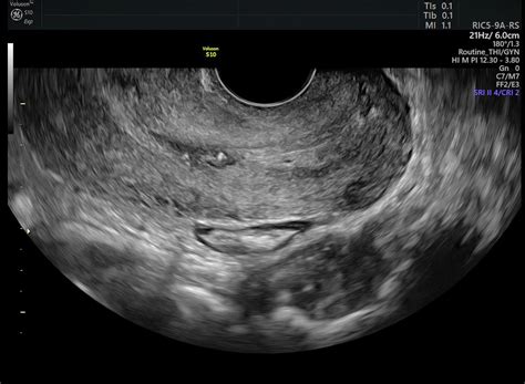 Cervical Lesions Ultrasound