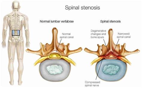 Back surgery, lower back surgery, indications, types, risks & complications