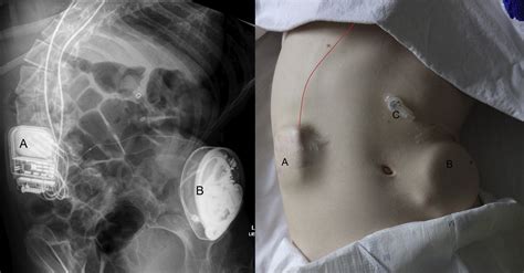 Resuscitation of a Patient With an Implanted Electronic Device - Annals ...