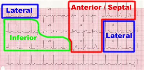 Infarction: Anterolateral Infarct Ecg