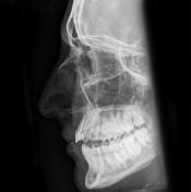 Nasal Bone Xray