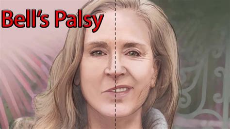 Bell's Palsy - Causes, Symptoms, Diagnosis, Recovery & Treatment