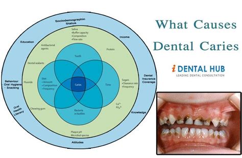 What Causes Dental Caries, Plaque & Tooth surface | Dental caries ...