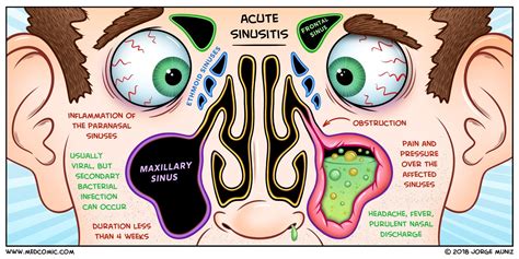 Acute Sinusitis BY JORGE MUNIZ, PA-C medcomic.com | Acute sinusitis ...