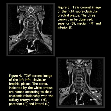 Brachial Plexus Injury Mri