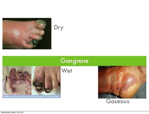 Gangrene symptoms