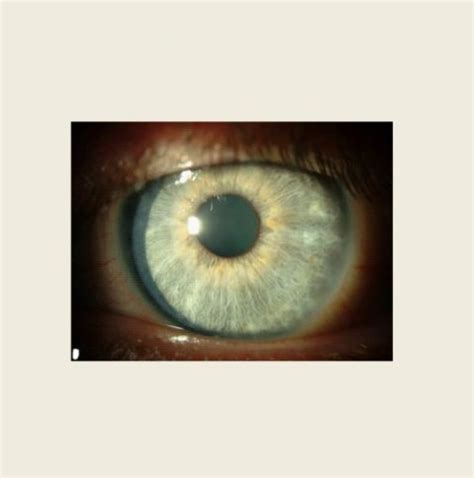 Keratitis - Causes, Signs & Symptoms and Treatment : MEDICUS