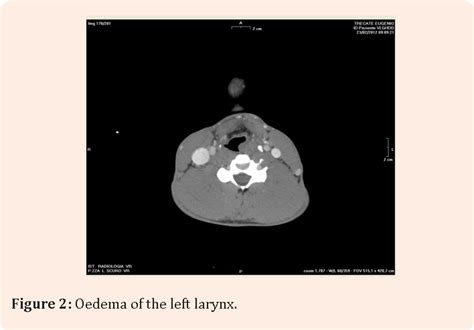 Figure 2 from Unsuspected Hyoid Bone Fracture Following a Sport ...