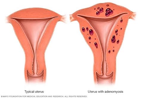 Adenomyosis - Mayo Clinic