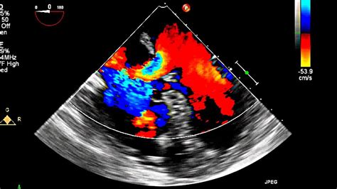 Atrial Septal Defect Primum Echocardiography - YouTube