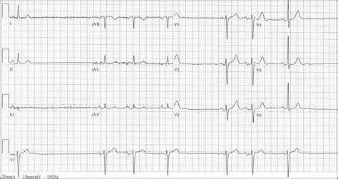 ECG Learning Center - An introduction to clinical electrocardiography