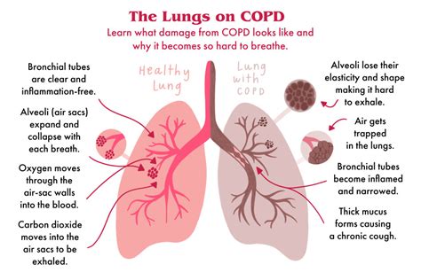 COPD: Here’s Exactly How It Affects Your Lungs