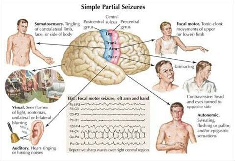 Seizures Epilepsy Symptoms, Seizure Symptoms, Epilepsy Facts, Temporal ...