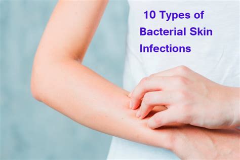 10 Types of Bacterial Skin Infections - Yabibo