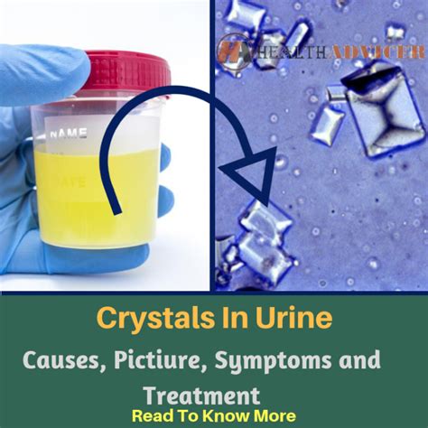 Crystals In Urine: Causes, Picture, Symptoms and Treatment