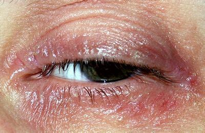 Eczema Around Eyes Treatment | Dyshidrotic Eczema Treatment